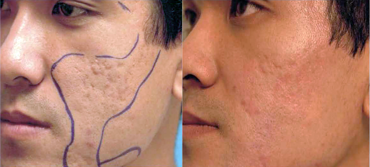 contour_acne_scar_treatment_on_asian_skin.jpg